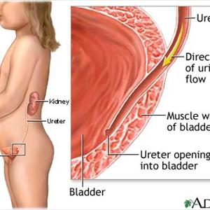 Causes Of Bladder Inflammation Blogs - Bladder Infection Treatment