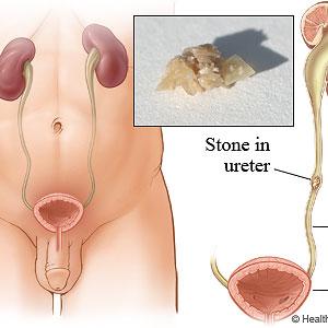 Natural Cure Uti - Natural Bladder Infection Remedies - How To Cure UTI With 3 Steps
