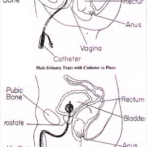 Symptoms Of A Uti - Urinary Tract Infection Home Remedies - 5 Remedies You Can Use Now