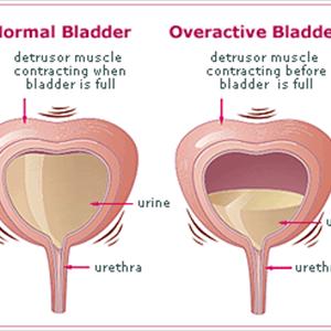 Causes Urinary Tract Infection - UTI Symptoms And Treatment For Men 